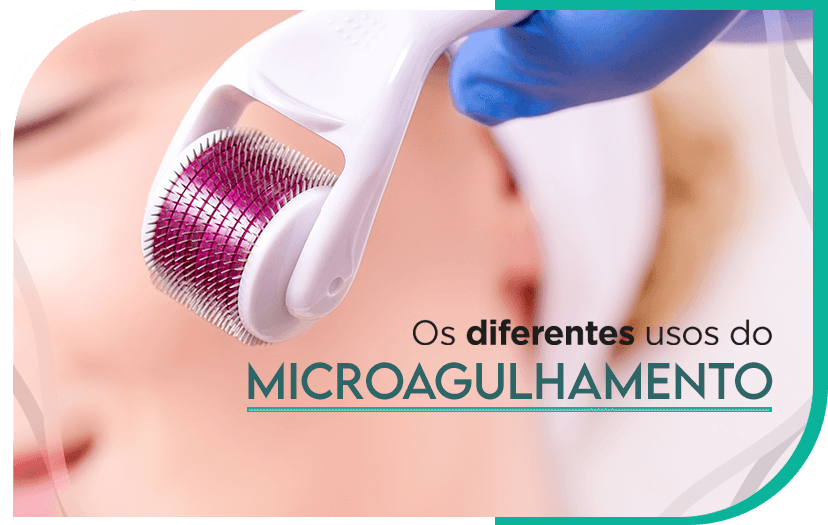 Os diferentes usos do microagulhamento